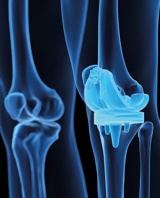 3d rendered medical illustration of a knee replacement